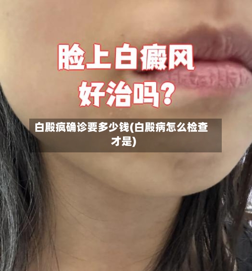白殿疯确诊要多少钱(白殿病怎么检查才是)-第2张图片