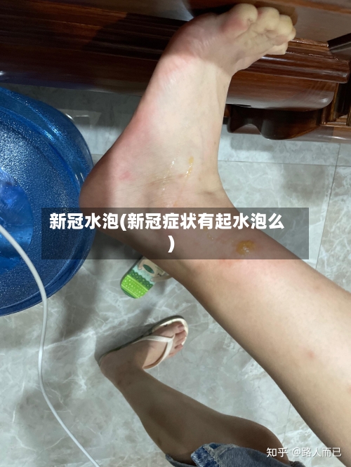 新冠水泡(新冠症状有起水泡么)