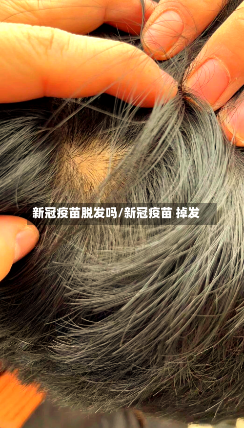 新冠疫苗脱发吗/新冠疫苗 掉发-第1张图片